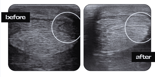 Echo voor en na lasertherapie — diepe buigpees