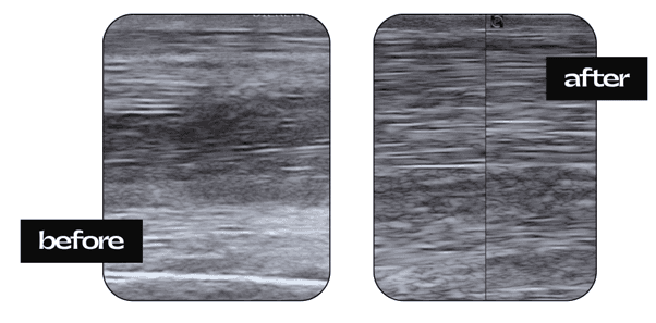 Echo voor en na lasertherapie — sportpony